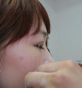 宜昌蕾帝整形張景雷雙眼皮案例分享