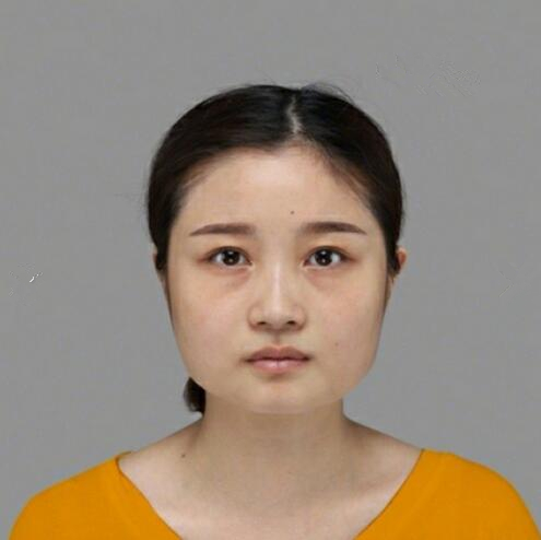 重慶美聯(lián)臣下頜角整形術(shù)后三個(gè)月效果反饋，一定要忌嘴