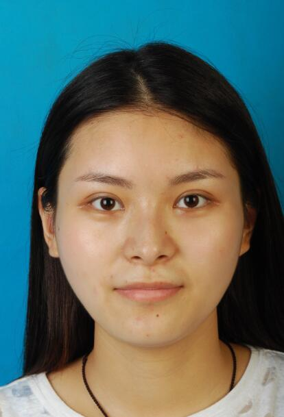 西安國際下頜角整形案例分享，怪不得都說整形要先輪廓后五官