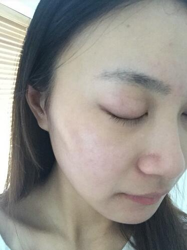 合肥艾雅整形紅藍(lán)光祛痘兩個療程效果，痘痘都消失了