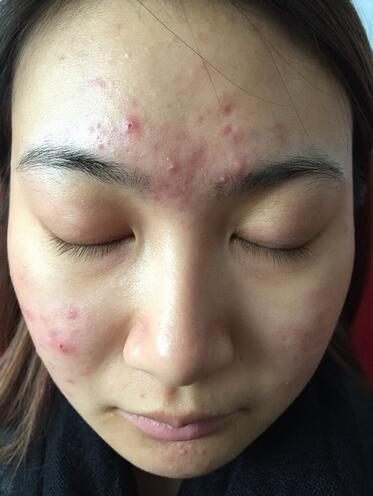 合肥艾雅整形紅藍(lán)光祛痘兩個療程效果，痘痘都消失了