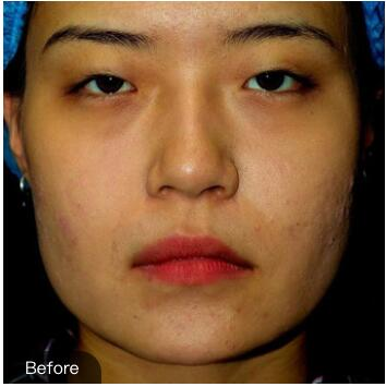 重慶華美下頜角整形術(shù)后兩個月效果反饋