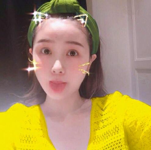 重慶美聯(lián)臣下頜角整形術(shù)后三個(gè)月效果反饋，一定要忌嘴