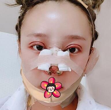 北京基礎(chǔ)美下頜角整形術(shù)后十天 北京基礎(chǔ)美下頜角整形術(shù)后十天