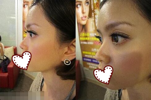 鄭州蘊(yùn)美整形玻尿酸隆鼻前 鄭州蘊(yùn)美整形玻尿酸隆鼻前