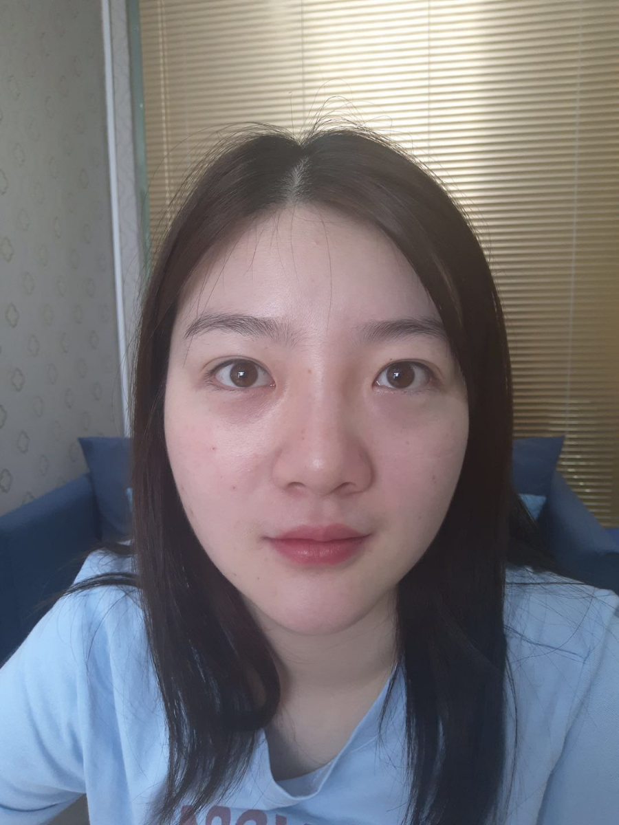 北京圣嘉榮二次鼻修復(fù)案例分享，做整形一定不要去莆田系醫(yī)院