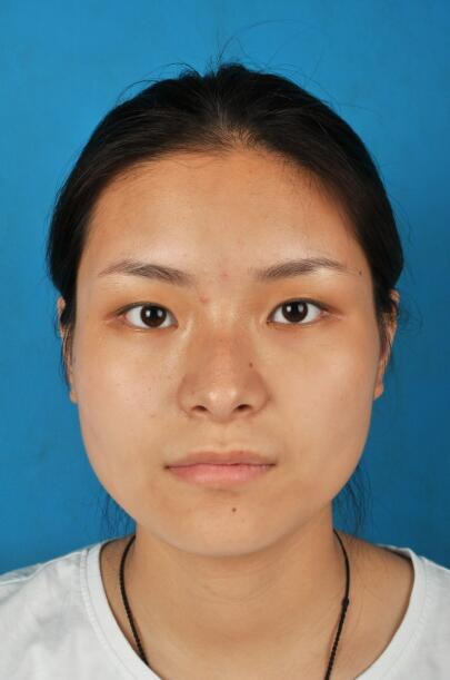 西安國際下頜角整形案例分享，怪不得都說整形要先輪廓后五官