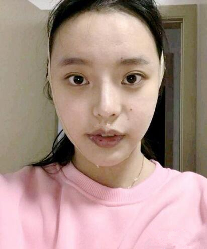 上海首爾麗格整形安建榮V-LINE瓜子臉手術(shù)一個月效果