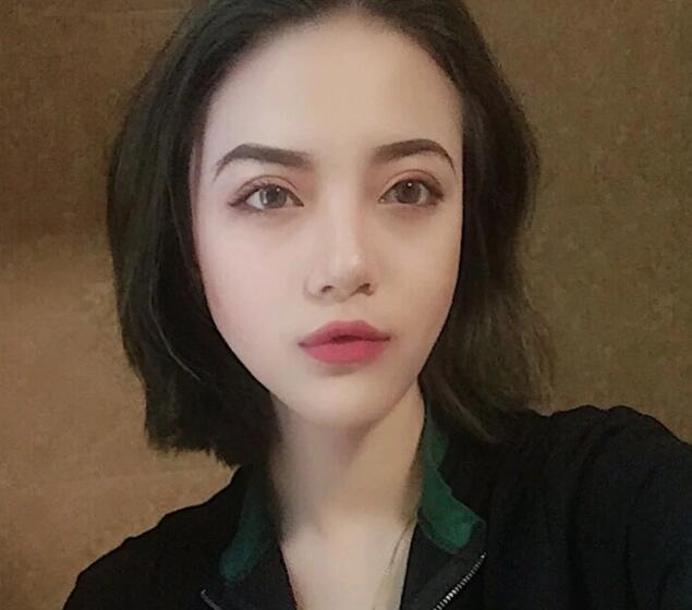 重慶華美下頜角整形術(shù)后一個月效果