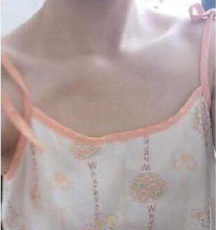 濟(jì)南悅美假體隆胸整形術(shù)前 濟(jì)南悅美假體隆胸整形術(shù)前