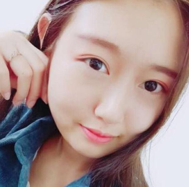 武漢伽美整形劉翼面部吸脂前效果 武漢伽美整形劉翼面部吸脂前效果