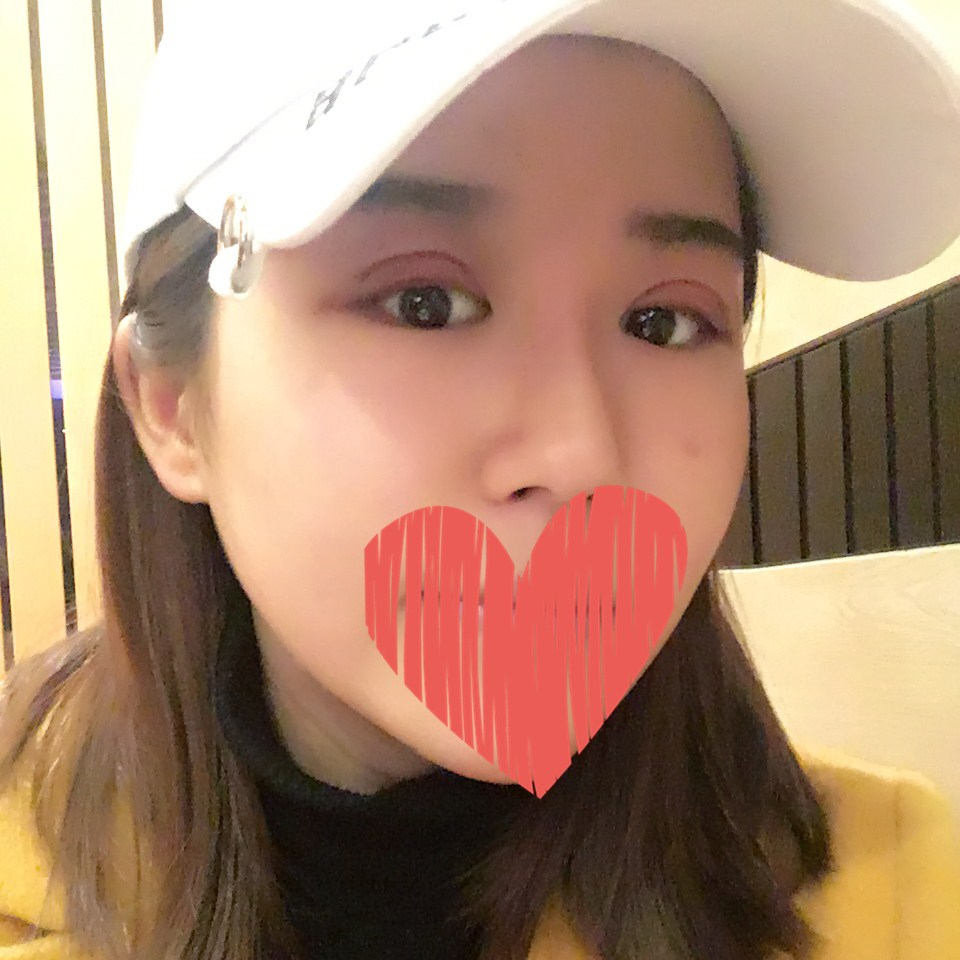 滄州中妤整形張明切開雙眼皮拆線后三天效果 滄州中妤整形張明切開雙眼皮拆線后三天效果