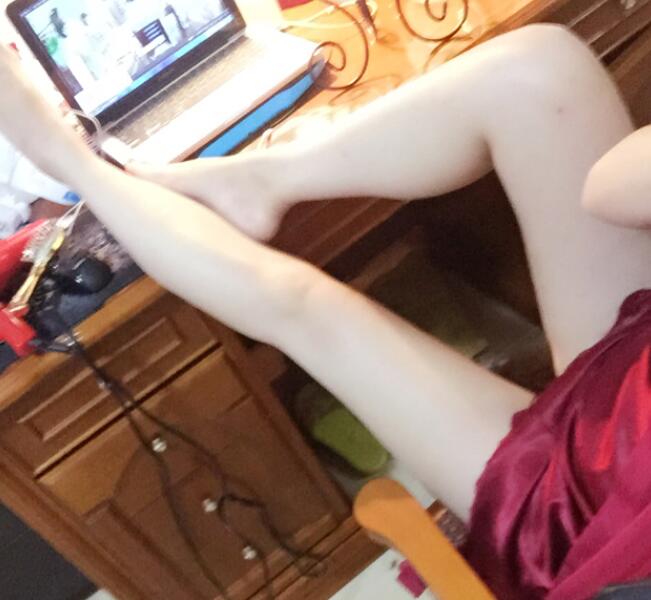 鄭州優(yōu)恩整形(原悅美)姚剛腿部吸脂三個(gè)月效果 鄭州優(yōu)恩整形(原悅美)姚剛腿部吸脂三個(gè)月效果