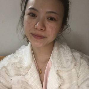 邯鄲佑熙整形孫堅激光祛斑前 邯鄲佑熙整形孫堅激光祛斑前