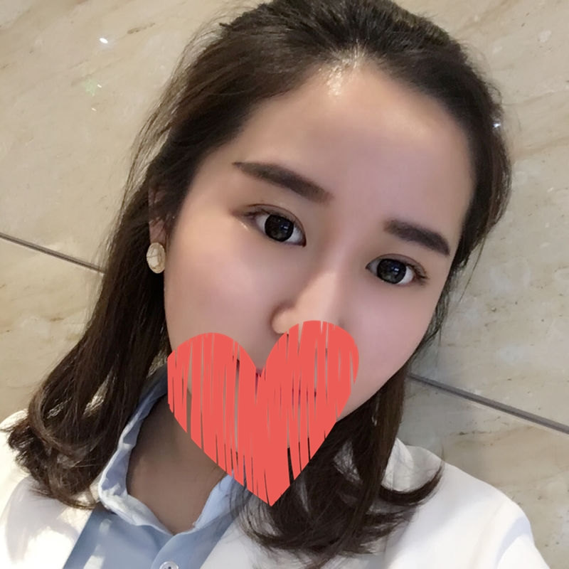 滄州中妤整形張明切開雙眼皮兩個(gè)月效果 滄州中妤整形張明切開雙眼皮兩個(gè)月效果