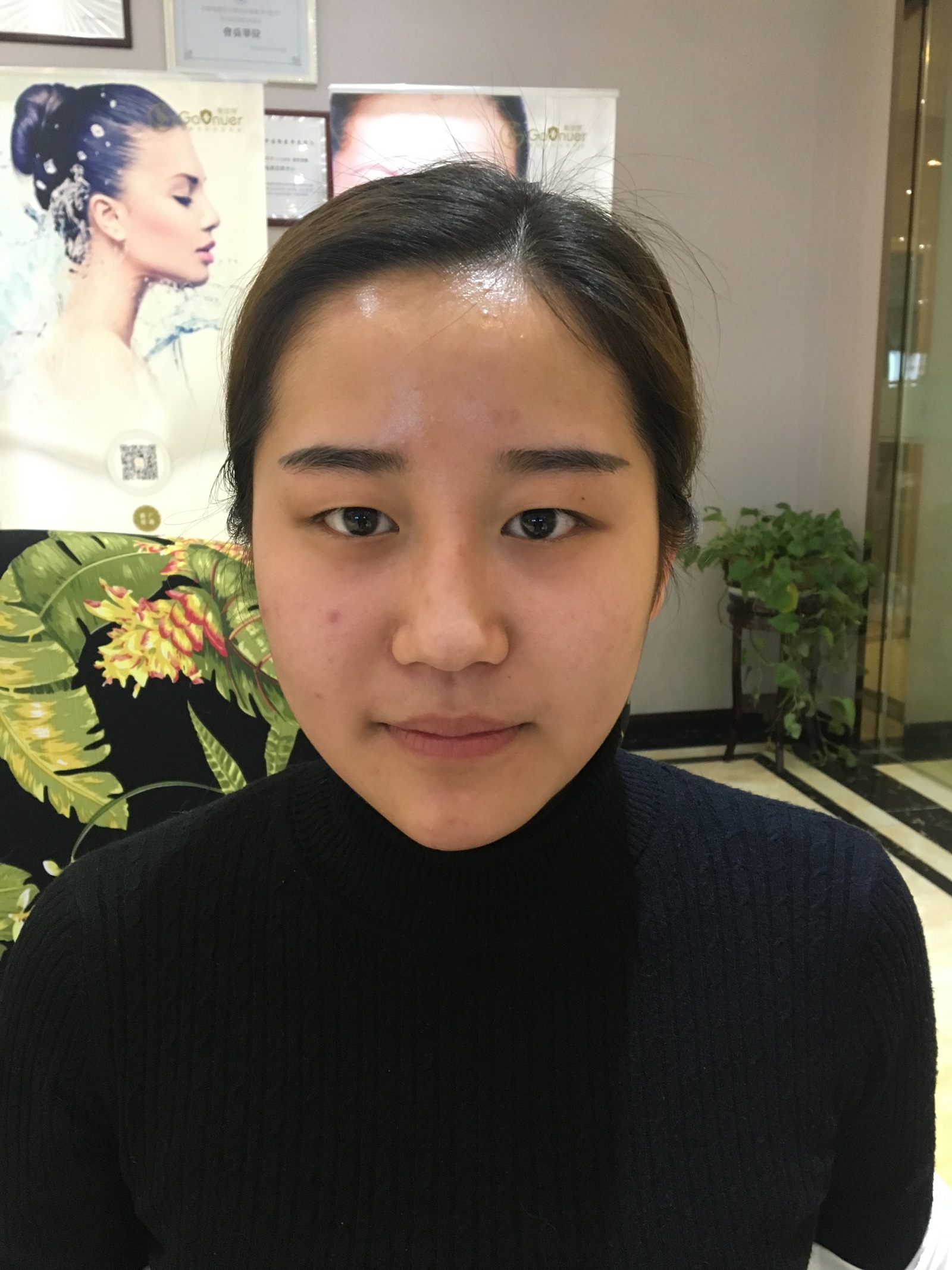 滄州中妤整形張明切開雙眼皮前 滄州中妤整形張明切開雙眼皮前