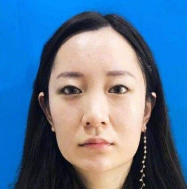 上海藝星整形崔海天下頜角整形術(shù)前效果 上海藝星整形崔海天下頜角整形術(shù)前效果