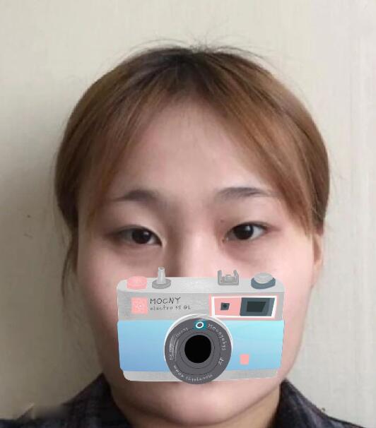 重慶華美整形下頜角整形術(shù)前效果