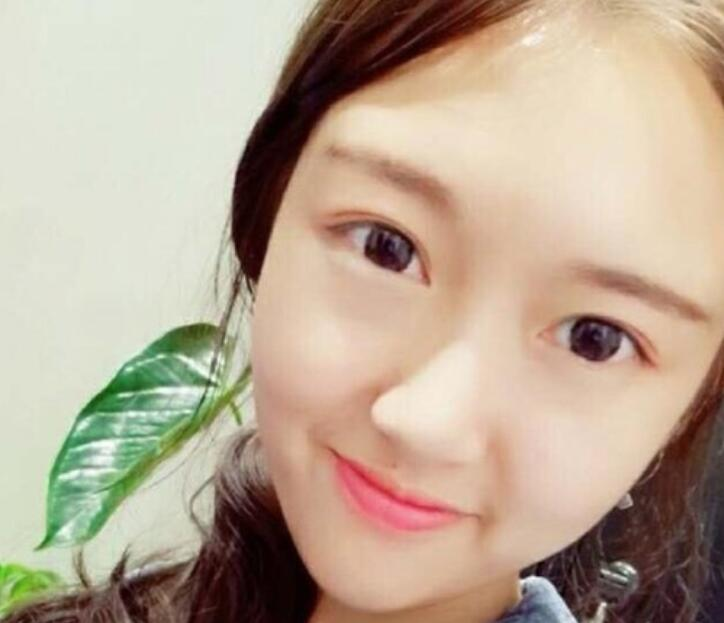 武漢伽美整形劉翼面部吸脂案例分享