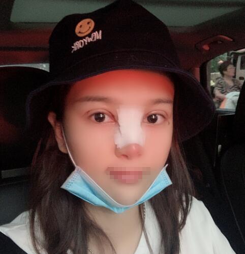 蘭州潤(rùn)妍整形鼻綜合術(shù)后三天效果 蘭州潤(rùn)妍整形鼻綜合術(shù)后三天效果