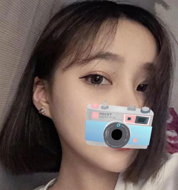 重慶華美整形下頜角整形術(shù)后一個多月效果