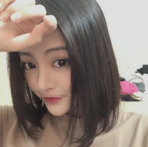 上海賽美瑞整形張化舉鼻綜合兩個月效果 上海賽美瑞整形張化舉鼻綜合兩個月效果