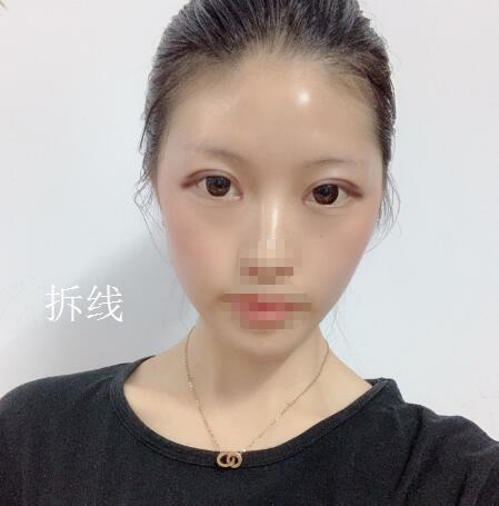 北京美萊整形杜園園雙眼皮拆線后效果 北京美萊整形杜園園雙眼皮拆線后效果