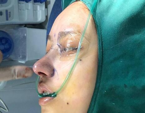 北京圣嘉榮整形呂玲玲硅膠隆鼻術(shù)后即刻 北京圣嘉榮整形呂玲玲硅膠隆鼻術(shù)后即刻