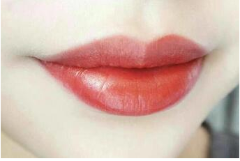 東南大學附屬中心大醫(yī)院整形外科厚唇改薄術(shù)后效果