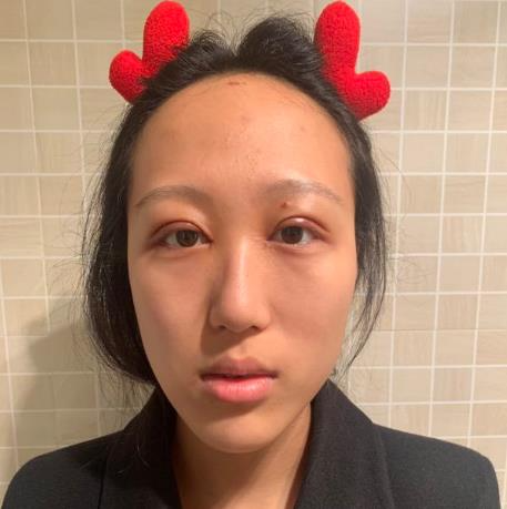 上海華美醫(yī)療美容醫(yī)院楊亞益做眼部修復整形怎么樣？