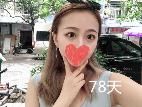 杭州靜港林忠泵埋線雙眼皮案例1-7天效果圖分享，讓你的眼睛魅力四射