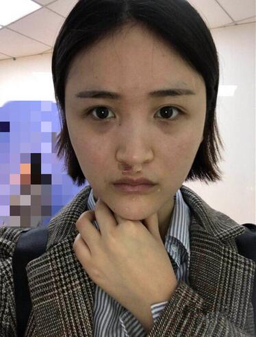 隆鼻術(shù)前效果 隆鼻術(shù)前效果