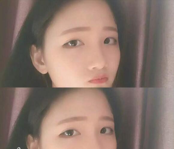 做切開雙眼皮恢復后的我 做切開雙眼皮恢復后的我