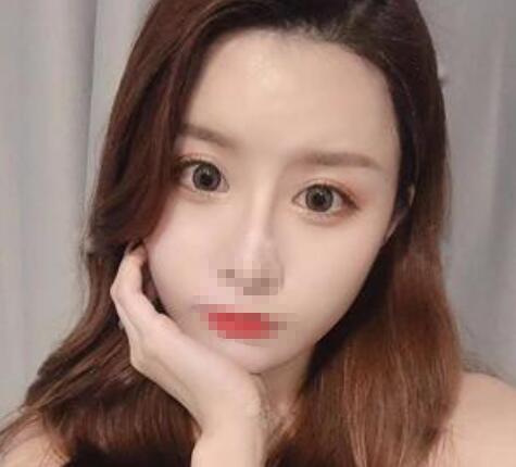 完全恢復后的雙眼皮效果 完全恢復后的雙眼皮效果