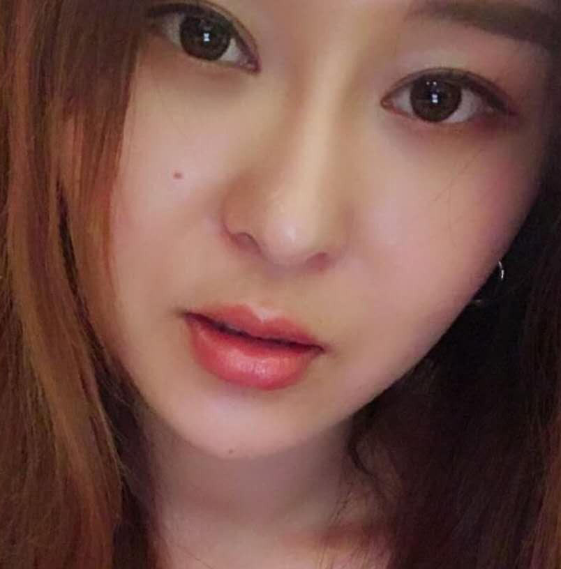 鄭州優(yōu)恩整形王波醫(yī)生玻尿酸豐唇案例效果對比圖