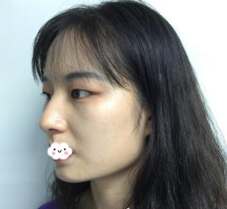 尖下頜角整形介紹 尖下頜角整形介紹