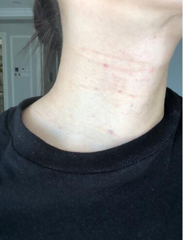 做完液態(tài)超聲刀注意什么。