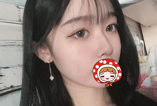 廈門海峽整形美容醫(yī)院醫(yī)生張宏隆鼻案例，效果很棒