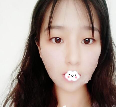 下頜角案例手術后: 下頜角案例手術后: