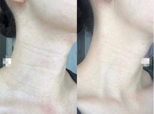 安徽韓美整形美容醫(yī)院吳美珍醫(yī)生液態(tài)超聲刀案例