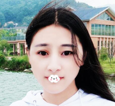 重慶美聯(lián)臣洪政槿醫(yī)生V臉整形案例效果圖對比