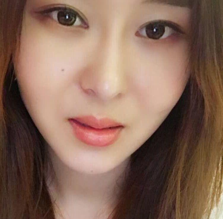 鄭州優(yōu)恩整形王波醫(yī)生玻尿酸豐唇案例 鄭州優(yōu)恩整形王波醫(yī)生玻尿酸豐唇案例