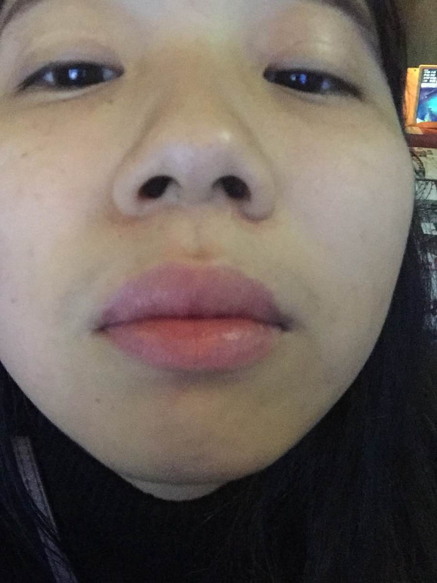 滄州瑞美醫(yī)療美容門診部王波醫(yī)生鼻骨縮窄案例，拯救了我的丑鼻子