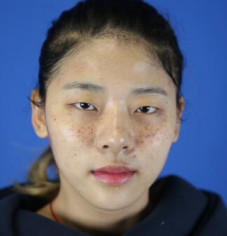 福州愛(ài)思特比華利整形林秋榮激光祛斑效果太贊了，終于沒(méi)人叫我“斑花”了