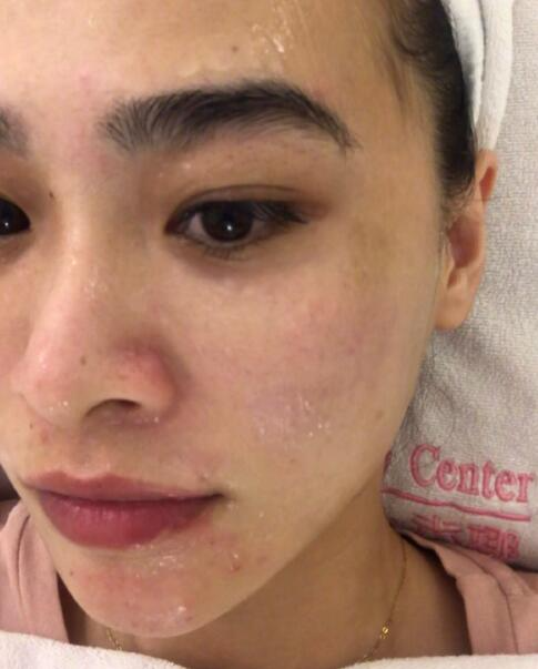 福州愛思特比華利整形林秋蓉醫(yī)生做光子嫩膚過(guò)程體驗(yàn)！皮膚Q彈