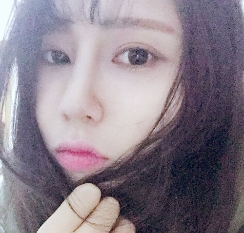 滄州瑞美醫(yī)療美容門診部王波醫(yī)生鼻骨縮窄案例，拯救了我的丑鼻子