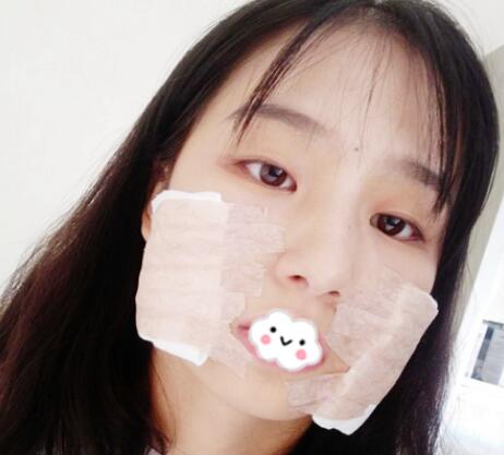 下頜角案例手術 下頜角案例手術