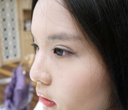 青島大學醫(yī)學院整形美容科陳振宇醫(yī)生做雙眼皮怎么樣？案例效果太驚艷