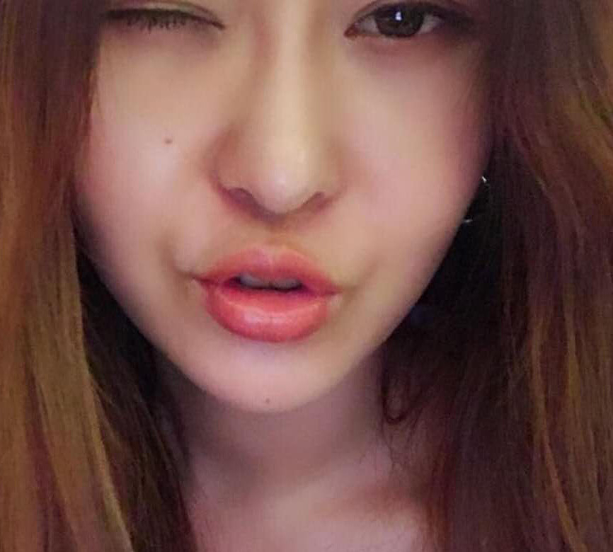 開始玻尿酸豐唇手術(shù) 開始玻尿酸豐唇手術(shù)