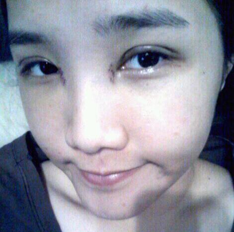 鄭州梨花雨整形美容醫(yī)院埋線雙眼皮案例效果對比圖